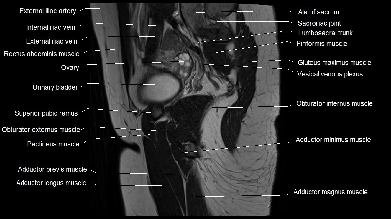 Hip sagittal cross sectional anatomy image 29.webp